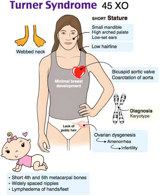 WBCS Zoology Notes On - Turner Syndrome IMAGE