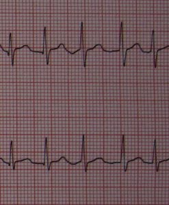 WBCS Causes Of Atrial Fibrillation - Medical Science Notes IMAGE