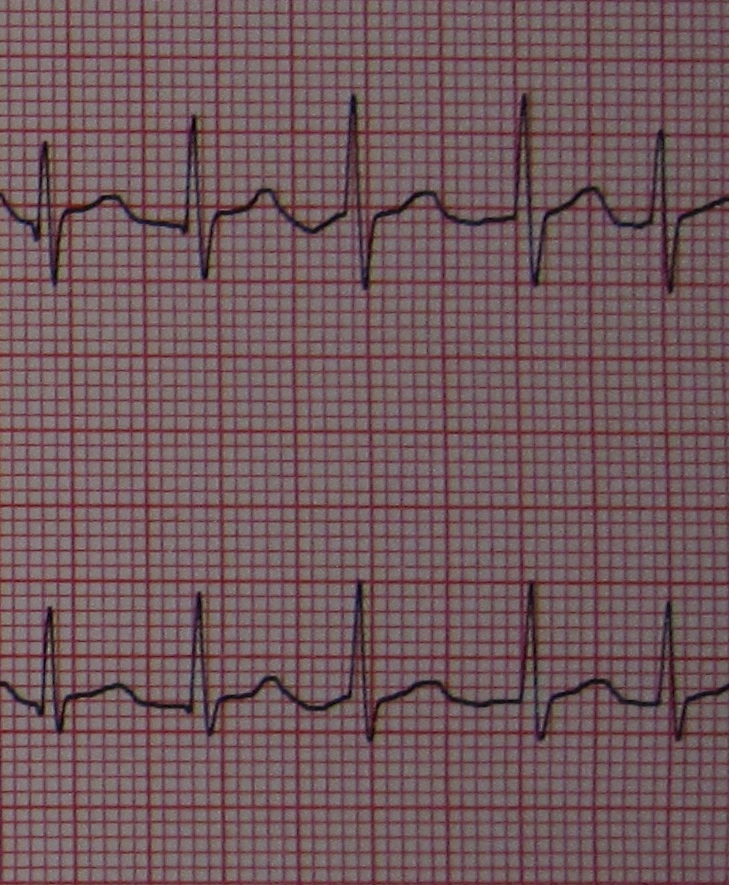 WBCS Causes Of Atrial Fibrillation - Medical Science Notes IMAGE