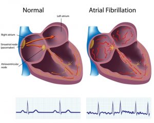WBCS Medical Science Notes - On - Atrial Fibrillation NOTES IMAGE