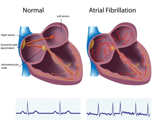 WBCS Medical Science Notes - On - Atrial Fibrillation NOTES IMAGE