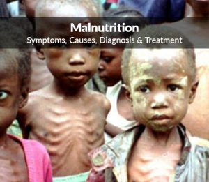 WBCS Essay Composition On - Malnutrition IMAGE