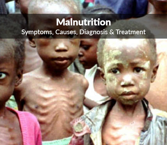 WBCS Essay Composition On - Malnutrition IMAGE