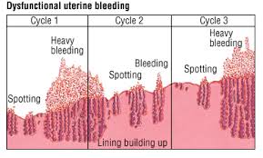WBCS Dysfunctional Uterine Bleeding - Medical Science Notes IMAGE