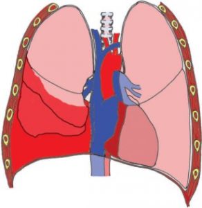 WBCS Medical Science Notes On - Haemothorax NOTES IMAGE