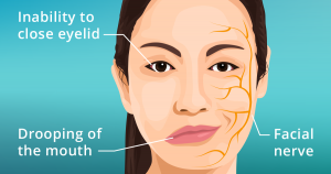 WBCS Bell's Palsy - Medical Science Notes IMAGE