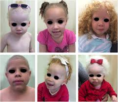 WBCS Zoology - Albinism NOTES IMAGE