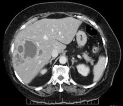 WBCS Medical Science - Liver Abscess NOTES IMAGE