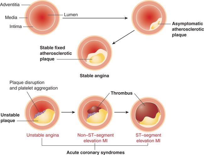 WBCS Medical Science - Unstable Angina NOTES IMAGE