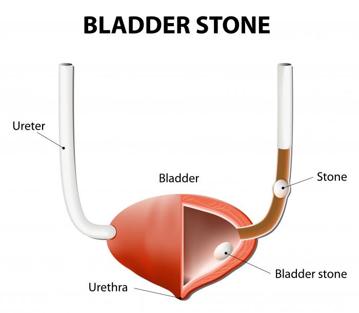 Medical-Science-Notes-On-–-Bladder-Stones-–-For-W.B.C.S.-Examination