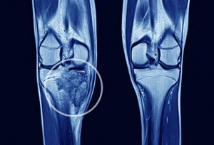 Notes-On-–-Bone-Tumor-–-Medical-Science-Notes-WBCS