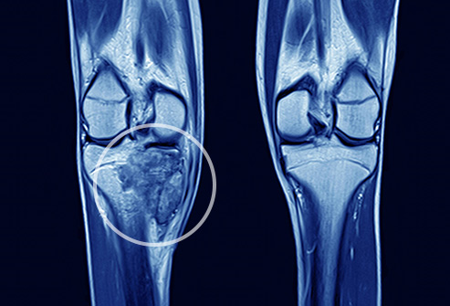 Notes-On-–-Bone-Tumor-–-Medical-Science-Notes-WBCS
